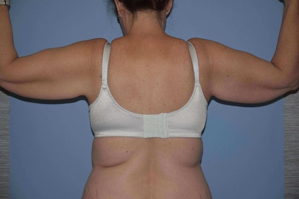 Before and After Arm Lift in Long Island