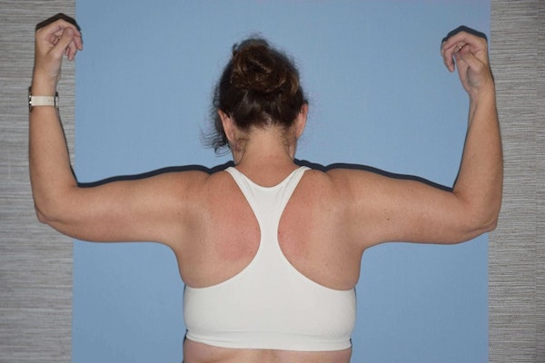 Before and After Arm Lift in Long Island