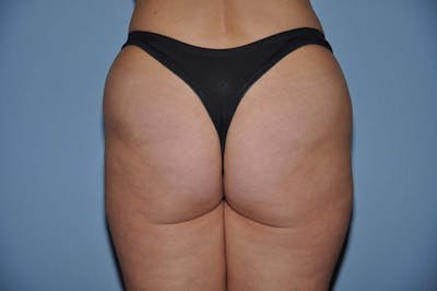 Brazilian Butt Lift Before & After Gallery - Patient 6389573 - Image 1