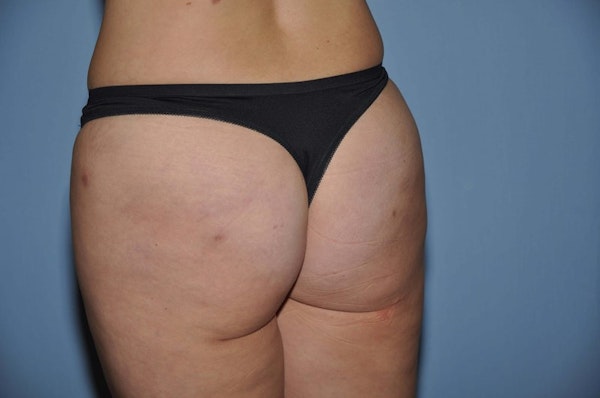 Brazilian Butt Lift Before & After Gallery - Patient 6389573 - Image 4