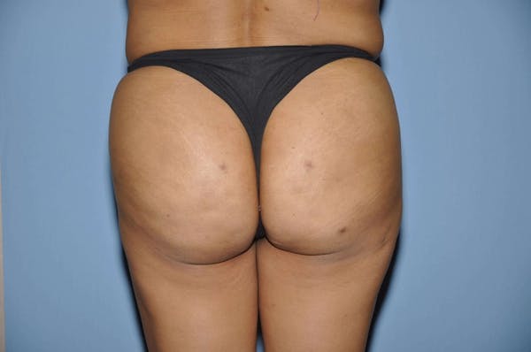 Brazilian Butt Lift Before & After Gallery - Patient 6389575 - Image 2