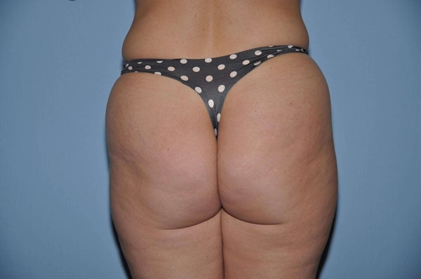 Before and After Brazilian Butt Lift in Long Island