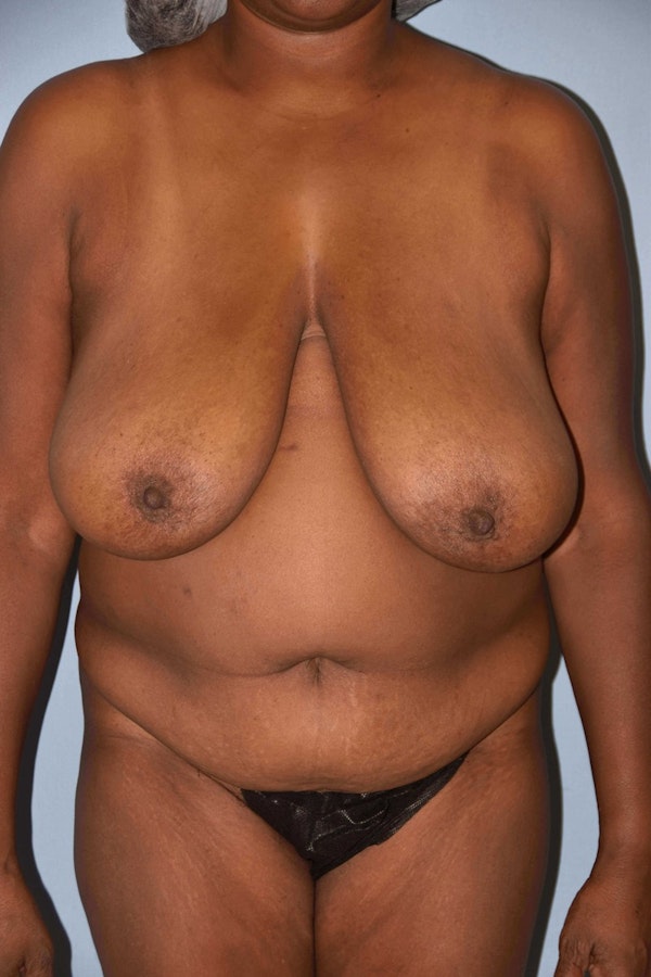Before and After of Mommy Makeover in Long Island