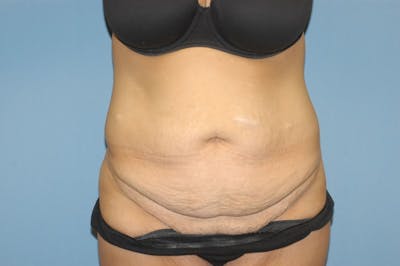 After Weight Loss Surgery Before & After Gallery - Patient 6389617 - Image 1