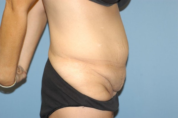After Weight Loss Surgery Before & After Gallery - Patient 6389617 - Image 5