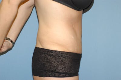 After Weight Loss Surgery Gallery - Patient 6389617 - Image 6