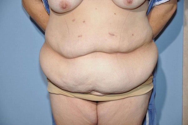 After Weight Loss