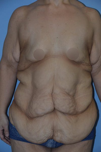 After Weight Loss Surgery Before & After Gallery - Patient 14281496 - Image 1