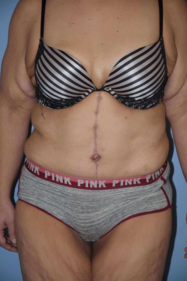 After Weight Loss Surgery Before & After Gallery - Patient 14281496 - Image 2