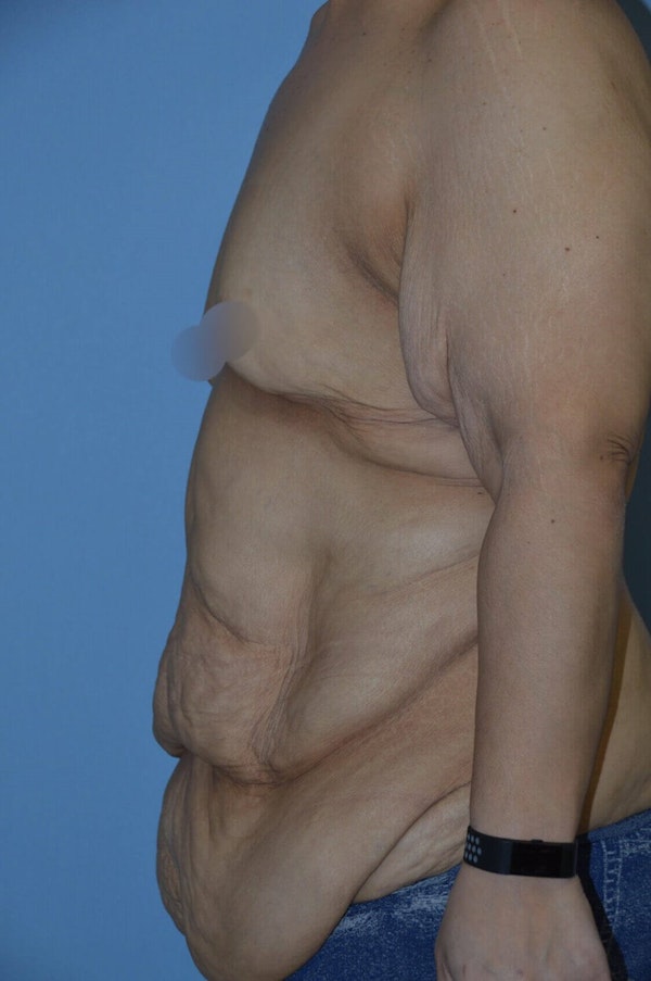 After Weight Loss Surgery Before & After Gallery - Patient 14281496 - Image 5