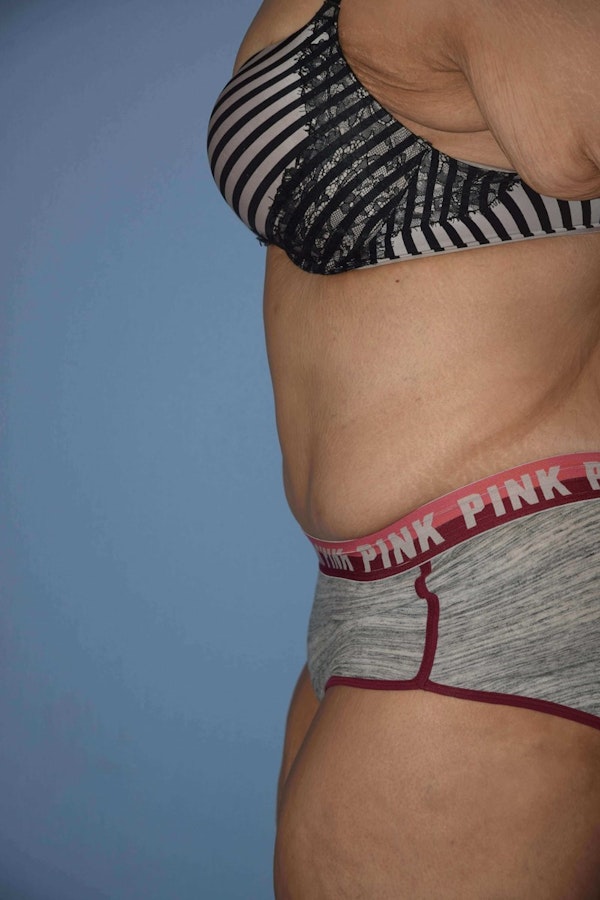 After Weight Loss Surgery Before & After Gallery - Patient 14281496 - Image 6