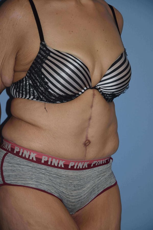 After Weight Loss Surgery Before & After Gallery - Patient 14281496 - Image 8
