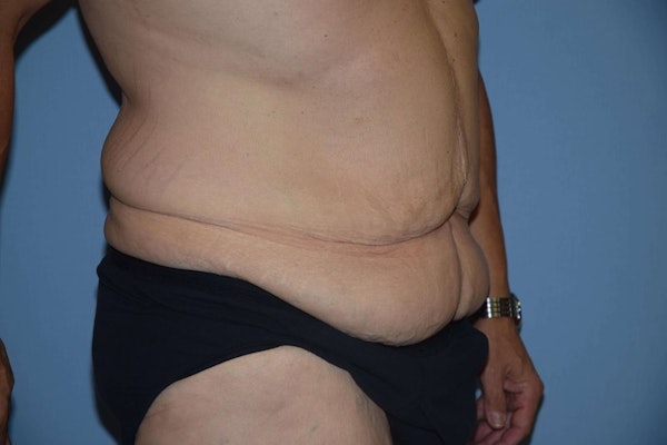 After Weight Loss Surgery Before & After Gallery - Patient 6389629 - Image 3