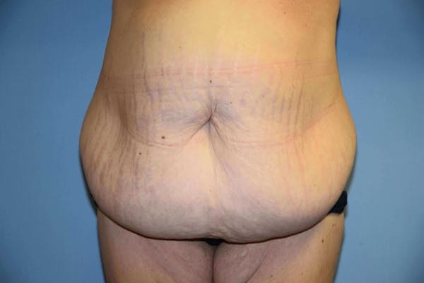 After Weight Loss Surgery Gallery - Patient 6389638 - Image 1
