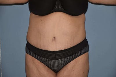 After Weight Loss Surgery Gallery - Patient 6389638 - Image 2