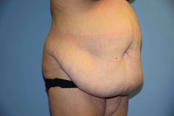 After Weight Loss Surgery Gallery - Patient 6389638 - Image 3