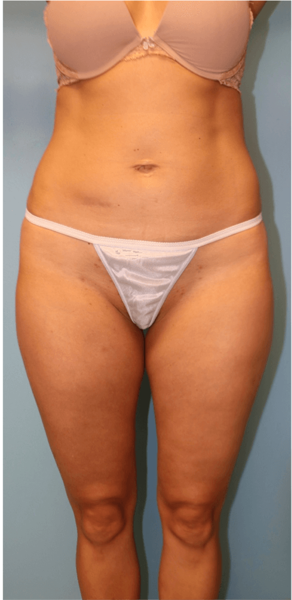 Liposuction before and after by Dr. Romanelli
