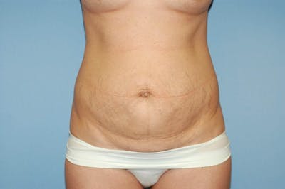 Tummy Tuck Before & After Gallery - Patient 6389675 - Image 1