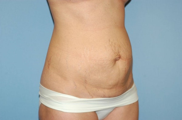 Tummy Tuck Before & After Gallery - Patient 6389675 - Image 3