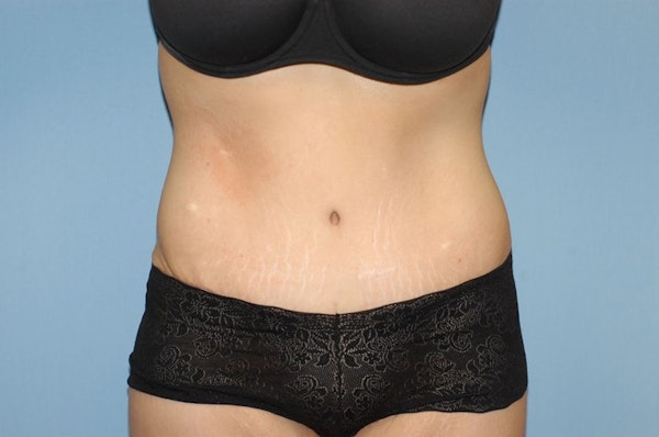 Tummy Tuck Before & After Gallery - Patient 6389677 - Image 2