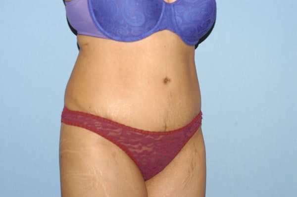 Tummy Tuck Before & After Gallery - Patient 6389678 - Image 4