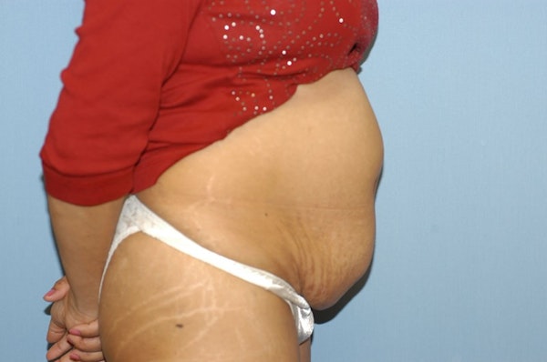 Tummy Tuck Before & After Gallery - Patient 6389678 - Image 5