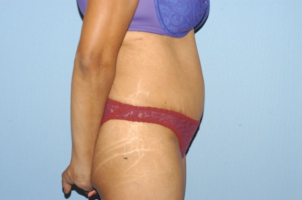 Tummy Tuck Before & After Gallery - Patient 6389678 - Image 6