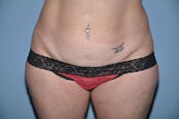Tummy Tuck Before & After Gallery - Patient 6389679 - Image 1