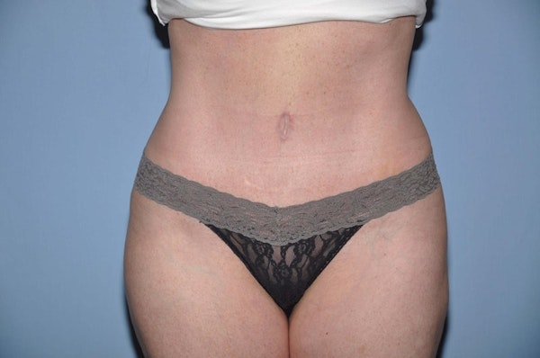 Tummy Tuck Before & After Gallery - Patient 6389679 - Image 2