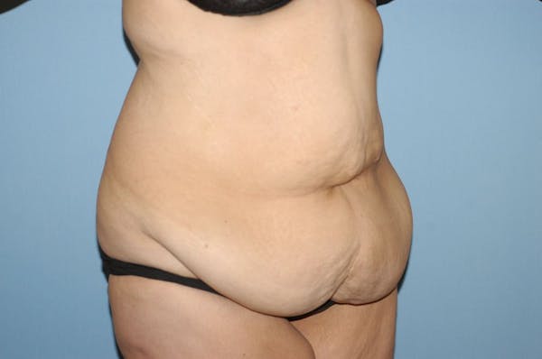 Tummy Tuck Gallery - Patient 6389681 - Image 3