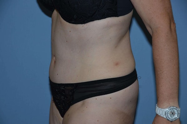 Tummy Tuck Before & After Gallery - Patient 6389682 - Image 4