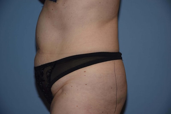 Tummy Tuck Before & After Gallery - Patient 6389682 - Image 5