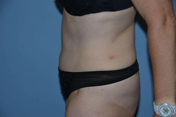 Tummy Tuck Before & After Gallery - Patient 6389682 - Image 6