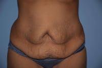Tummy Tuck Before & After Gallery - Patient 6389683 - Image 1