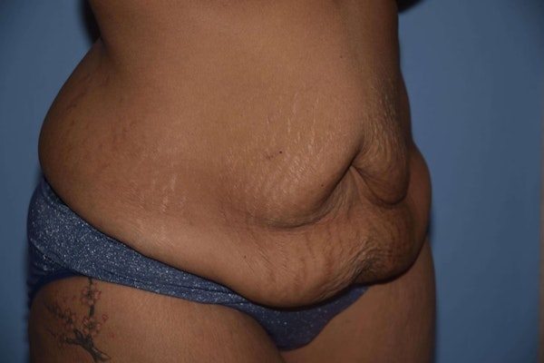 Tummy Tuck Before & After Gallery - Patient 6389683 - Image 3