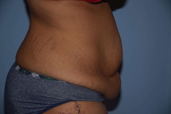 Tummy Tuck Before & After Gallery - Patient 6389683 - Image 5