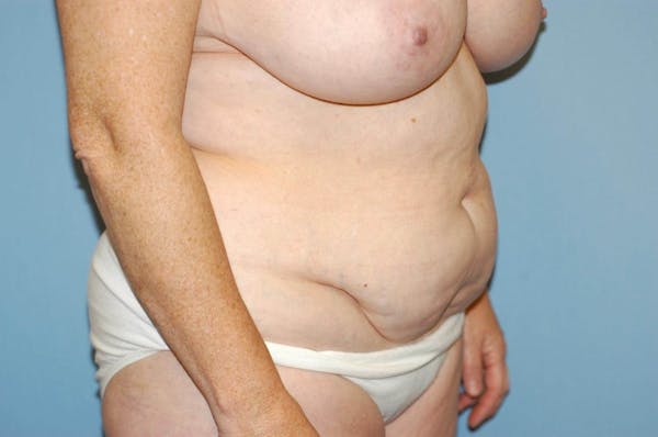 Tummy Tuck Gallery - Patient 6389688 - Image 3