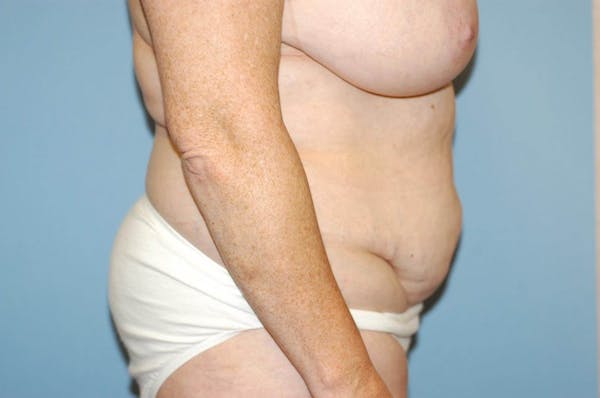 Tummy Tuck Gallery - Patient 6389688 - Image 5
