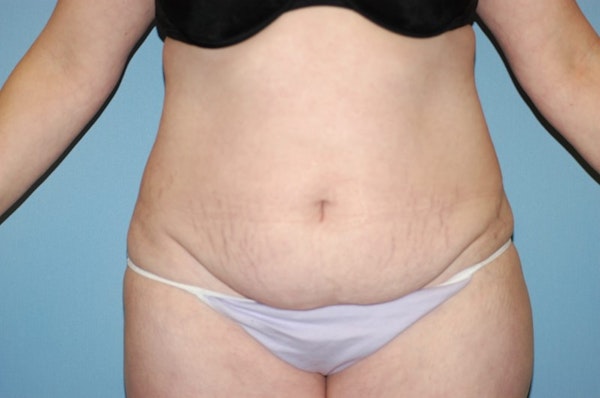 Tummy Tuck Before & After Gallery - Patient 6389689 - Image 1