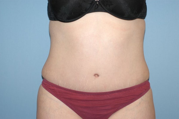 Tummy Tuck Before & After Gallery - Patient 6389689 - Image 2