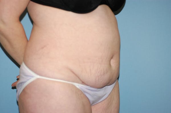 Tummy Tuck Before & After Gallery - Patient 6389689 - Image 3