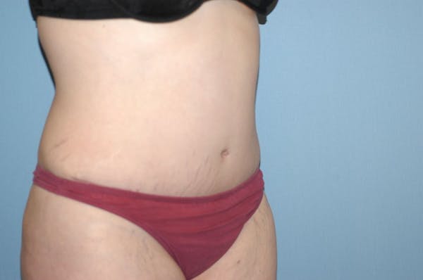 Tummy Tuck Before & After Gallery - Patient 6389689 - Image 4