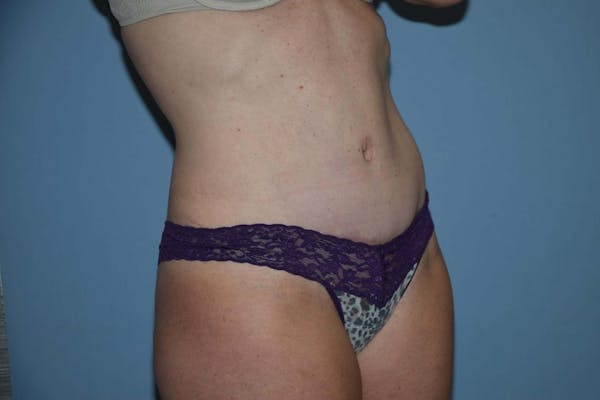 Tummy Tuck Before & After Gallery - Patient 6389691 - Image 4