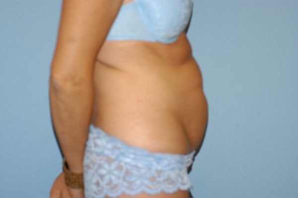 Tummy Tuck Before & After Gallery - Patient 6389692 - Image 5