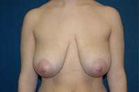 Breast Lift Before & After Gallery - Patient 6389703 - Image 1