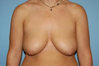 Breast Lift Before & After Gallery - Patient 6389704 - Image 1