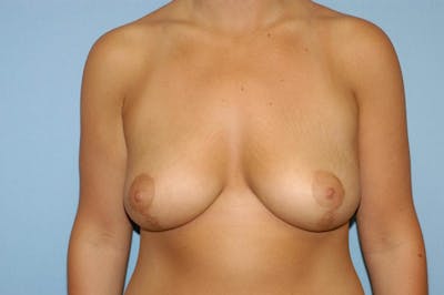 Breast Lift Before & After Gallery - Patient 6389704 - Image 2
