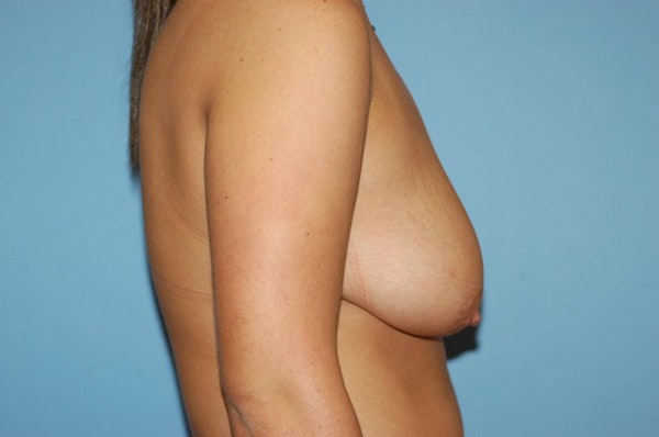 Breast Lift Before & After Gallery - Patient 6389704 - Image 5