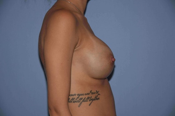 Breast Revision Before & After Gallery - Patient 6389724 - Image 6