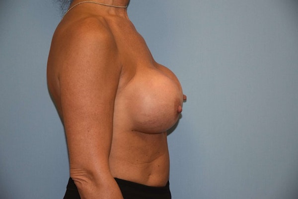 Breast Revision Before & After Gallery - Patient 6389725 - Image 5
